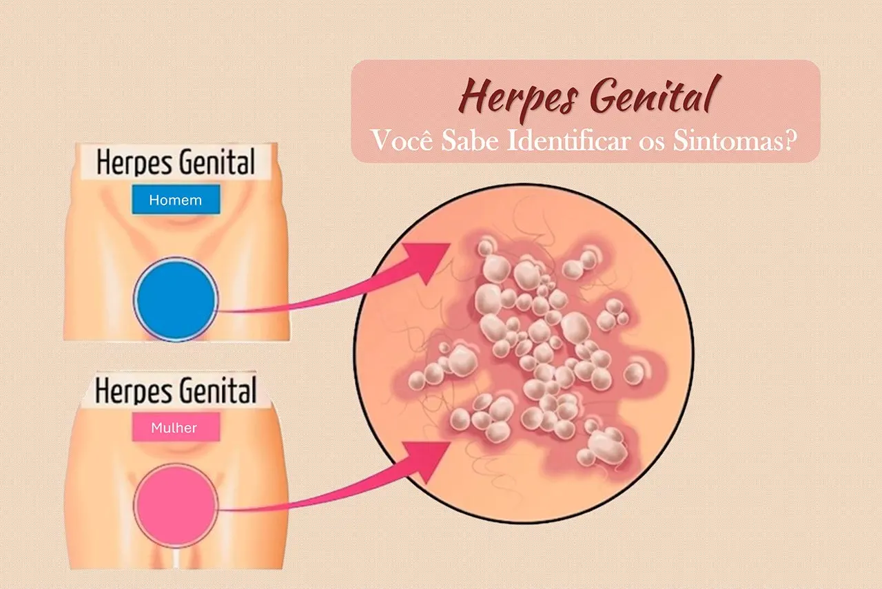 Herpes Genital: Voc&ecirc; Sabe Identificar os Sintomas?