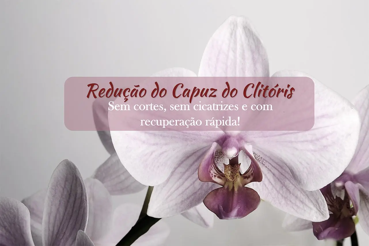 Redu&ccedil;&atilde;o do Capuz do Clit&oacute;ris sem Cortes: T&eacute;cnica Inovadora