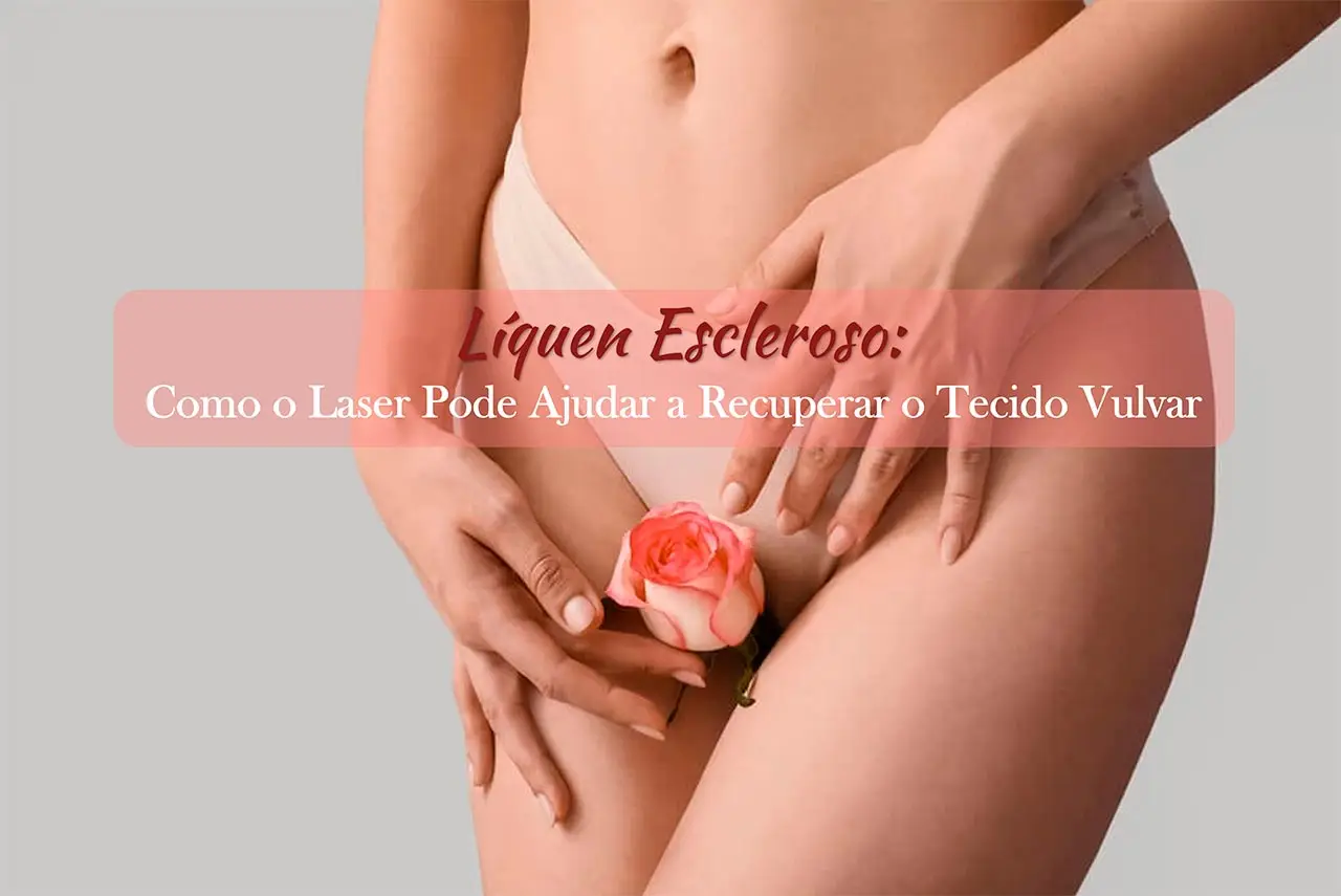 L&iacute;quen Escleroso: Como o Laser Pode Ajudar a Recuperar o Tecido Vulvar